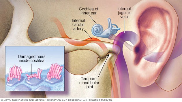 Graphic of ear showing tinnitus